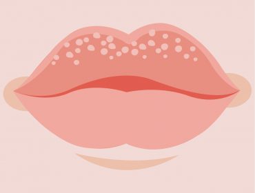 fordyce spots lips