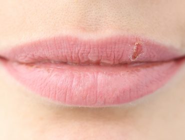 canker sore std