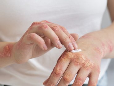 herpes on fingers