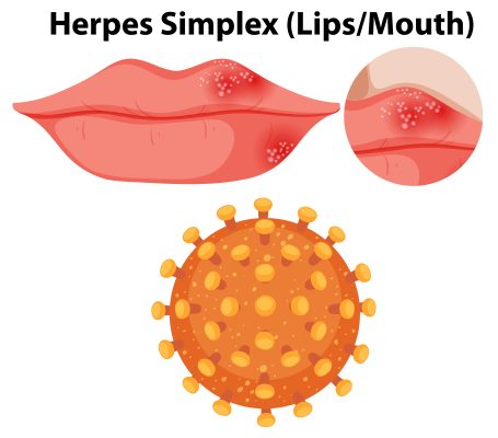 herpes simplex encephalitis