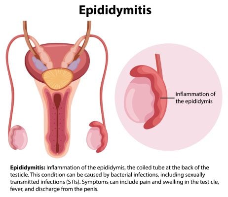 spermatocele symptoms lead to epididymitis