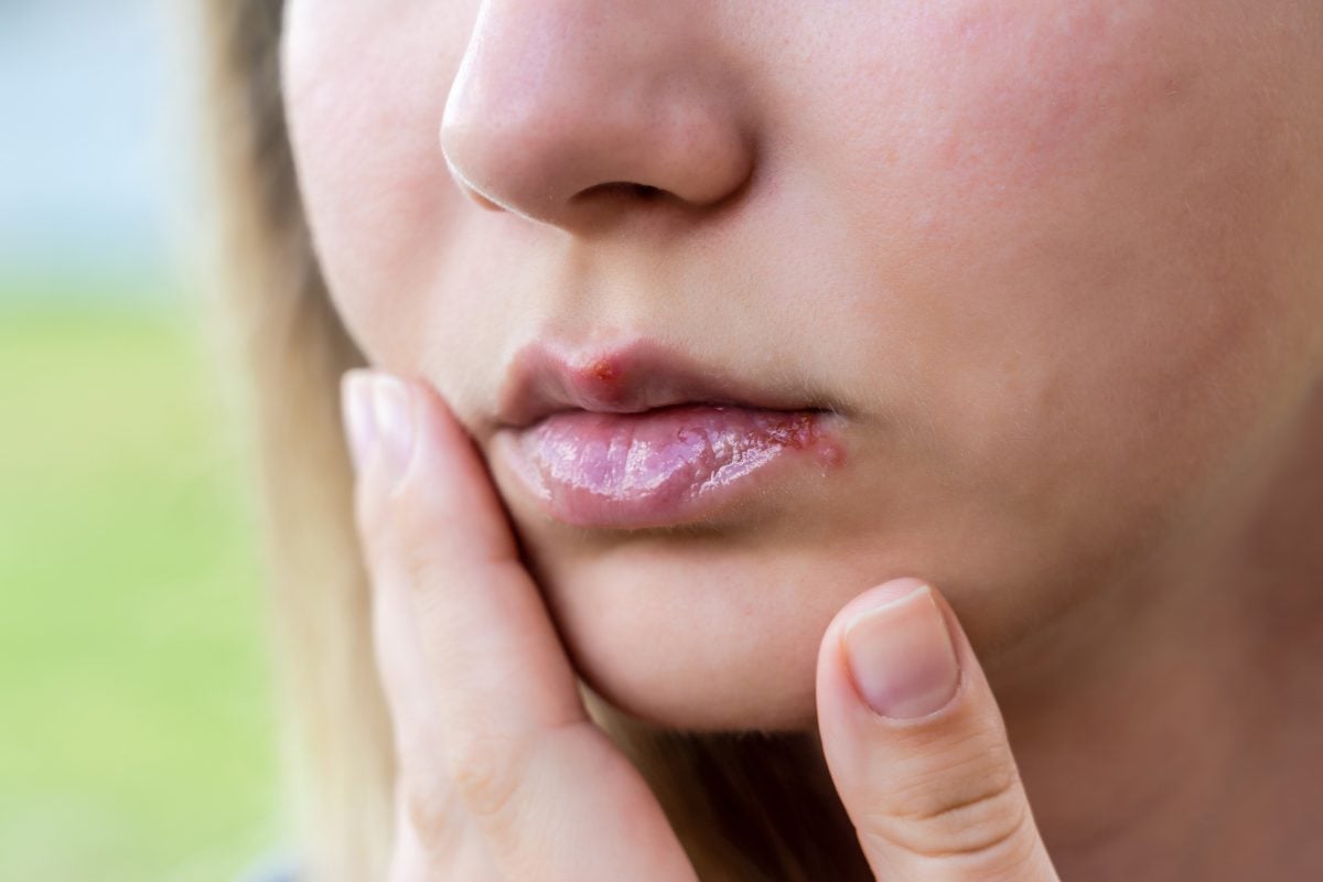Cold sore on lips, Can you get genital herpes from a cold sore?