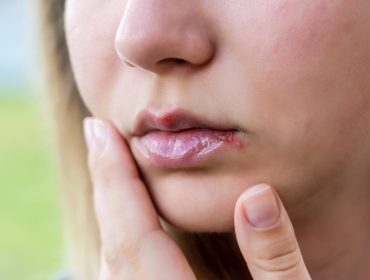 Cold sore on lips, Can you get genital herpes from a cold sore?